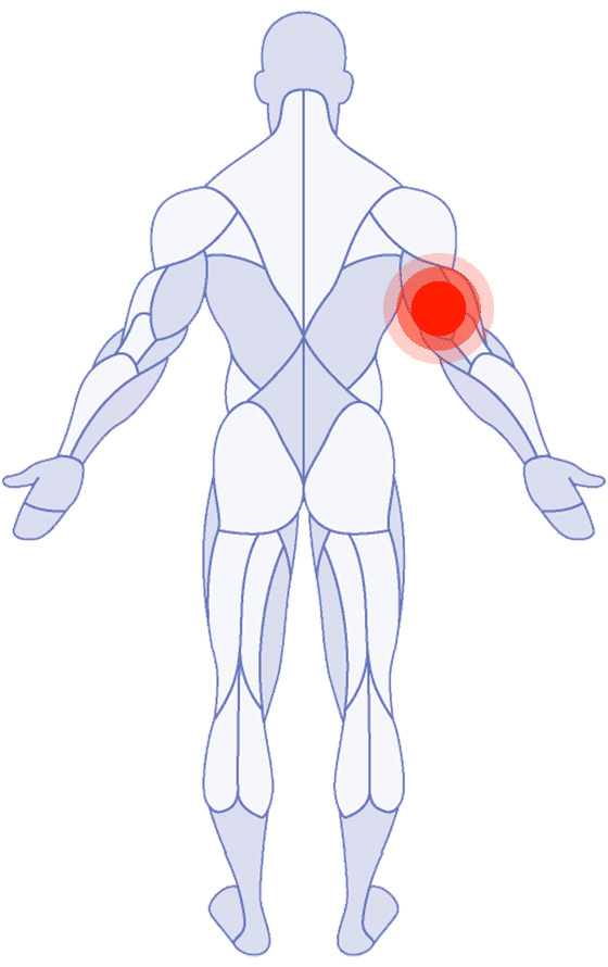 Tricep Pain
